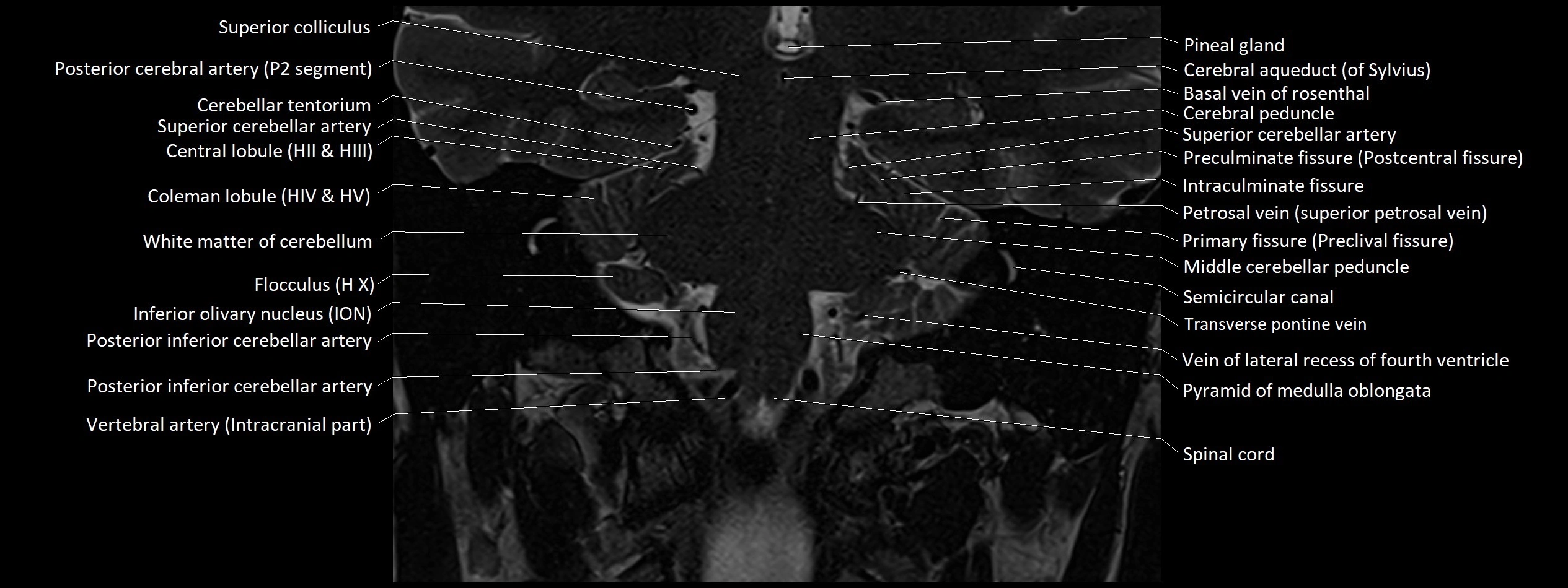 Anatomy of cerebellum coronal cross sectional 3T image 4.webp